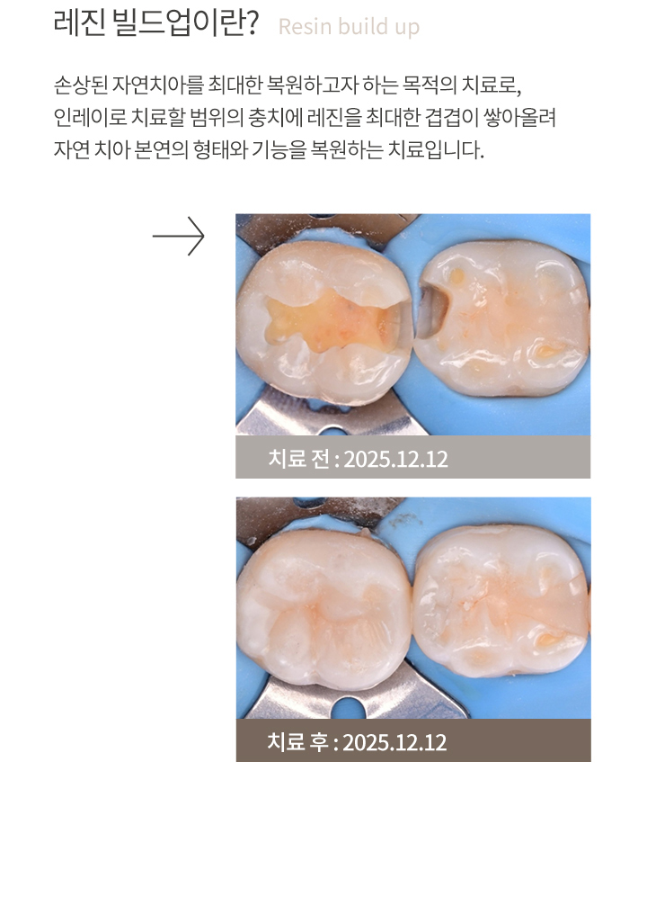 불완전한 레진치료로 인한 통증