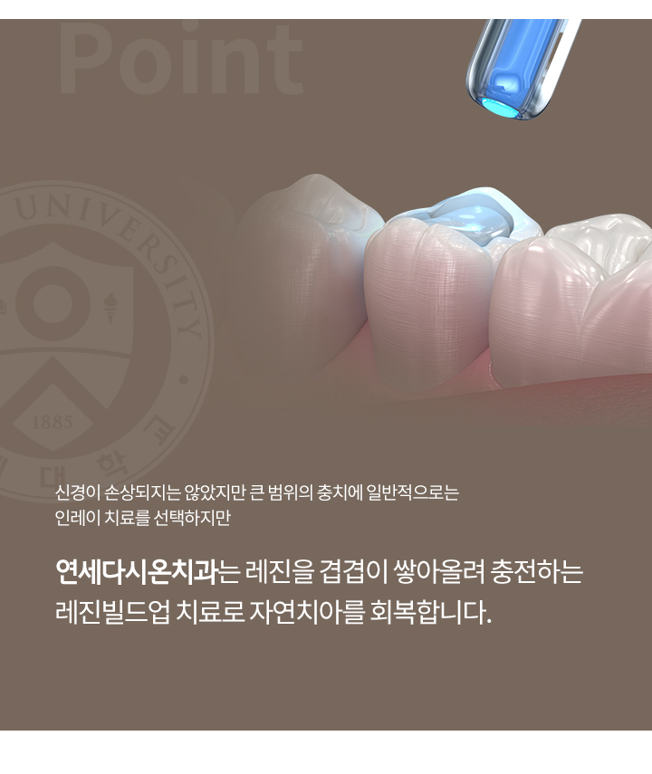 재발성 충치 및 2차 우식 가능성