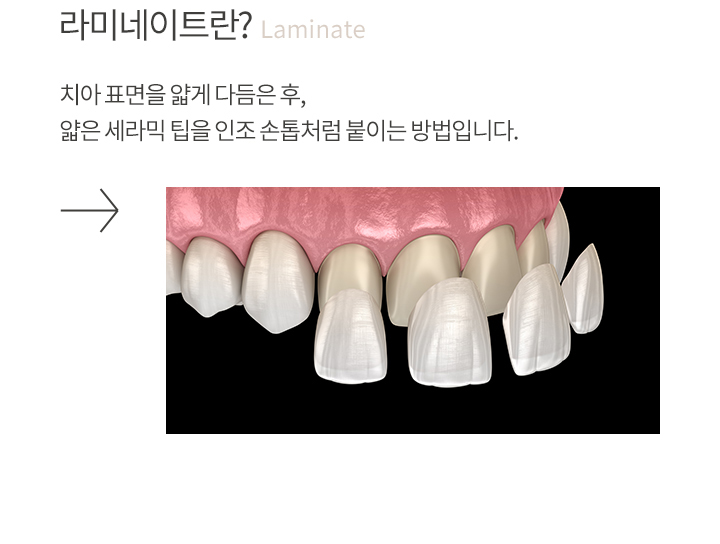 라미네이트란? Laminate - 치아 표면을 얇게 다듬은 후, 얇은 세라믹 팁을 인조 손톱처럼 붙이는 방법