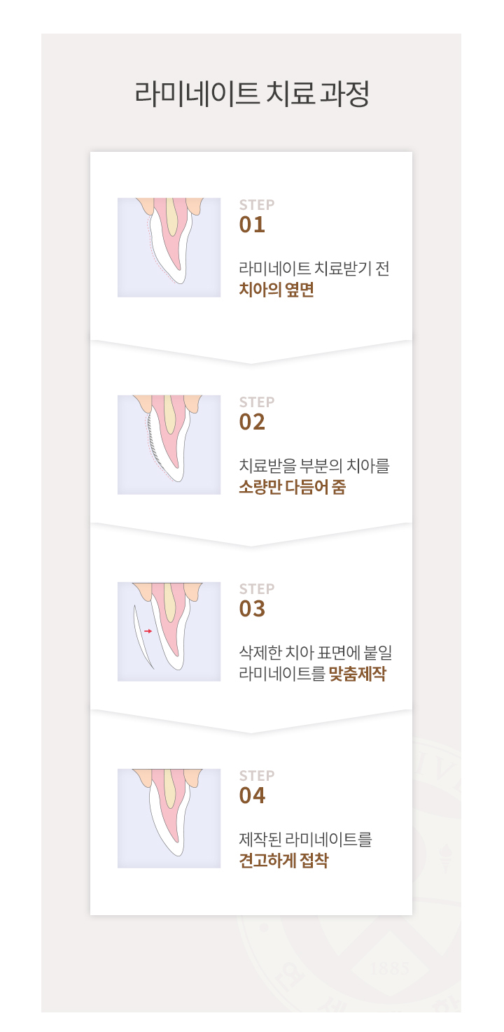 라미네이트 치료 과정 - STEP 01 치료 전 치아, 02 소량 삭제, 03 맞춤 제작, 04 접착