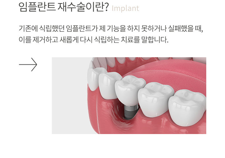 임플란트 재수술 소개
