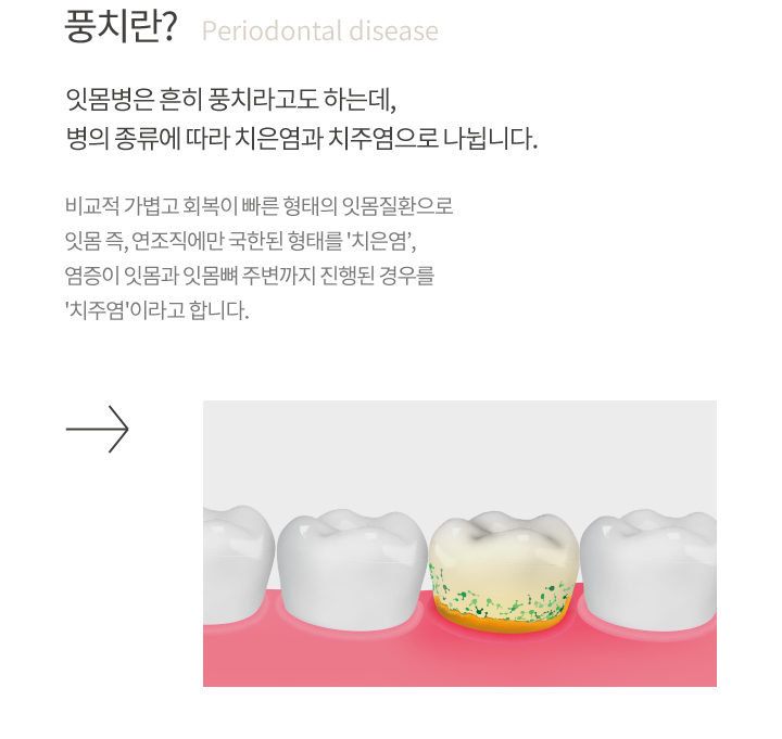 프리미엄 잇몸치료 소개