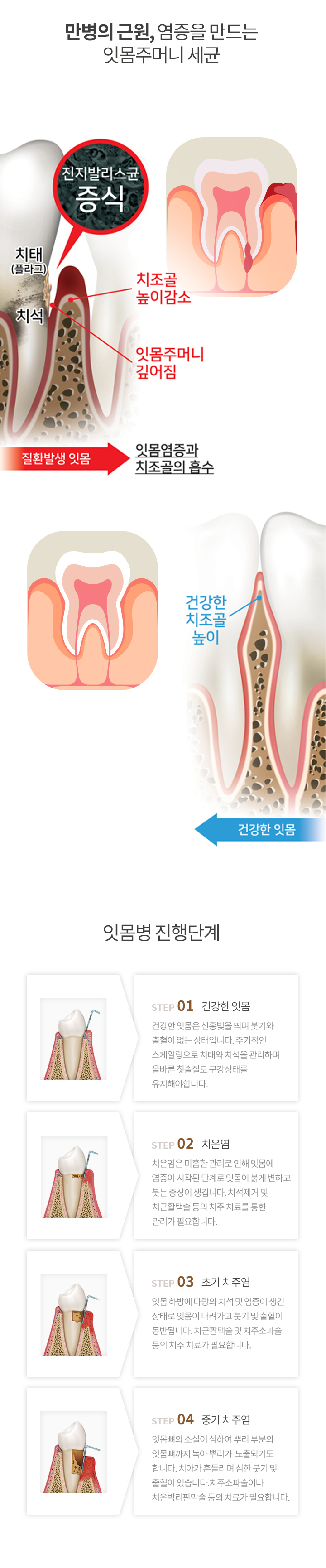 프리미엄 잇몸치료 과정
