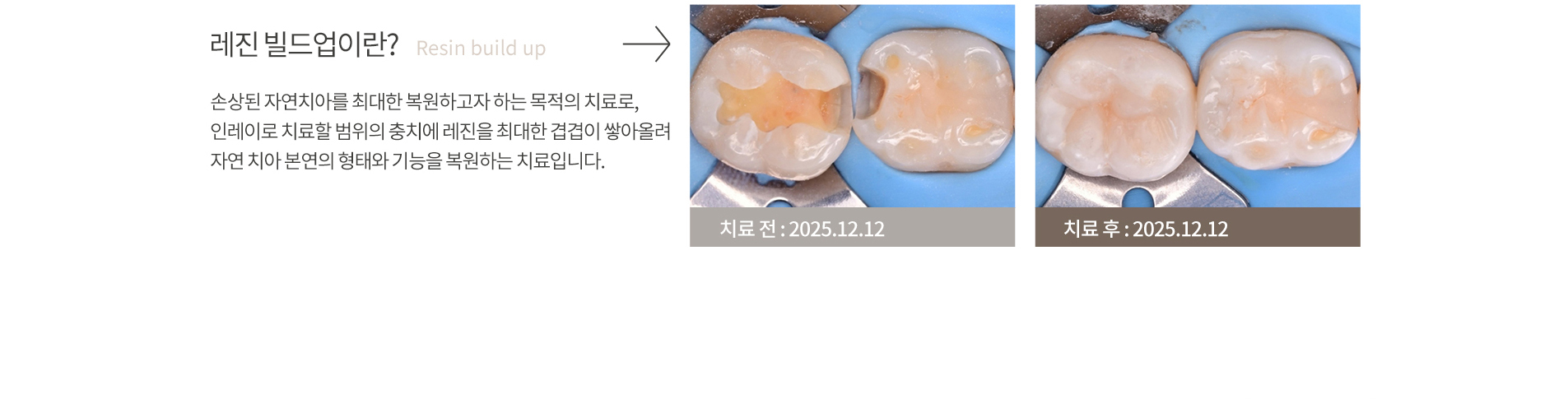 불완전한 레진치료로 인한 통증