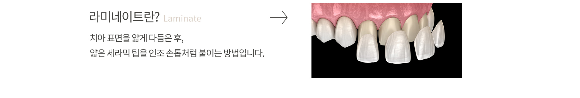 라미네이트란? Laminate - 치아 표면을 얇게 다듬은 후, 얇은 세라믹 팁을 인조 손톱처럼 붙이는 방법