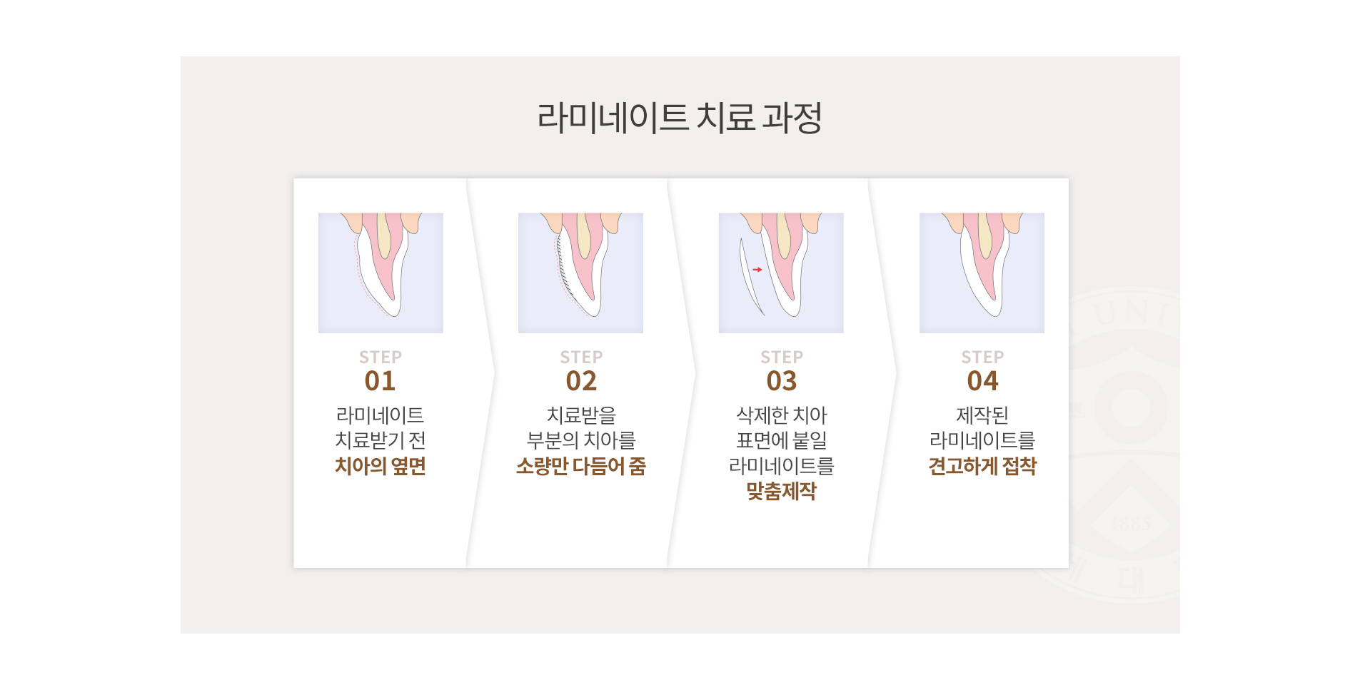 라미네이트 치료 과정 - STEP 01 치료 전 치아, 02 소량 삭제, 03 맞춤 제작, 04 접착