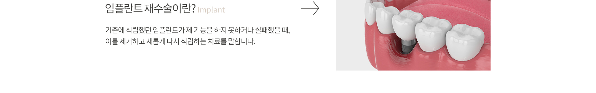 임플란트 재수술 소개