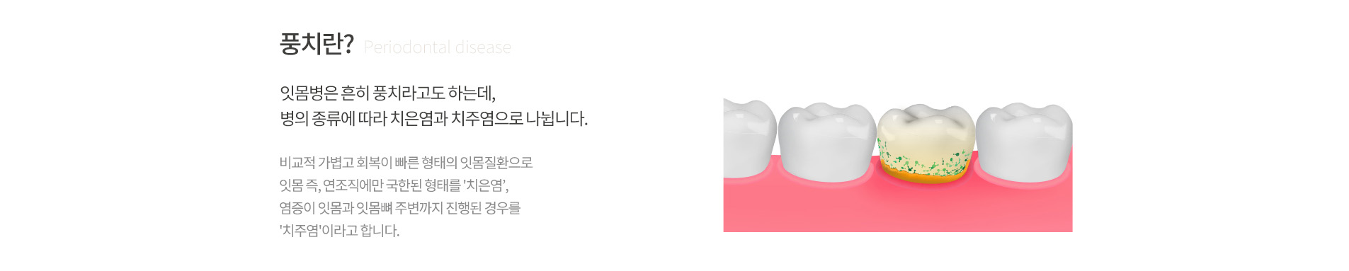 프리미엄 잇몸치료 소개