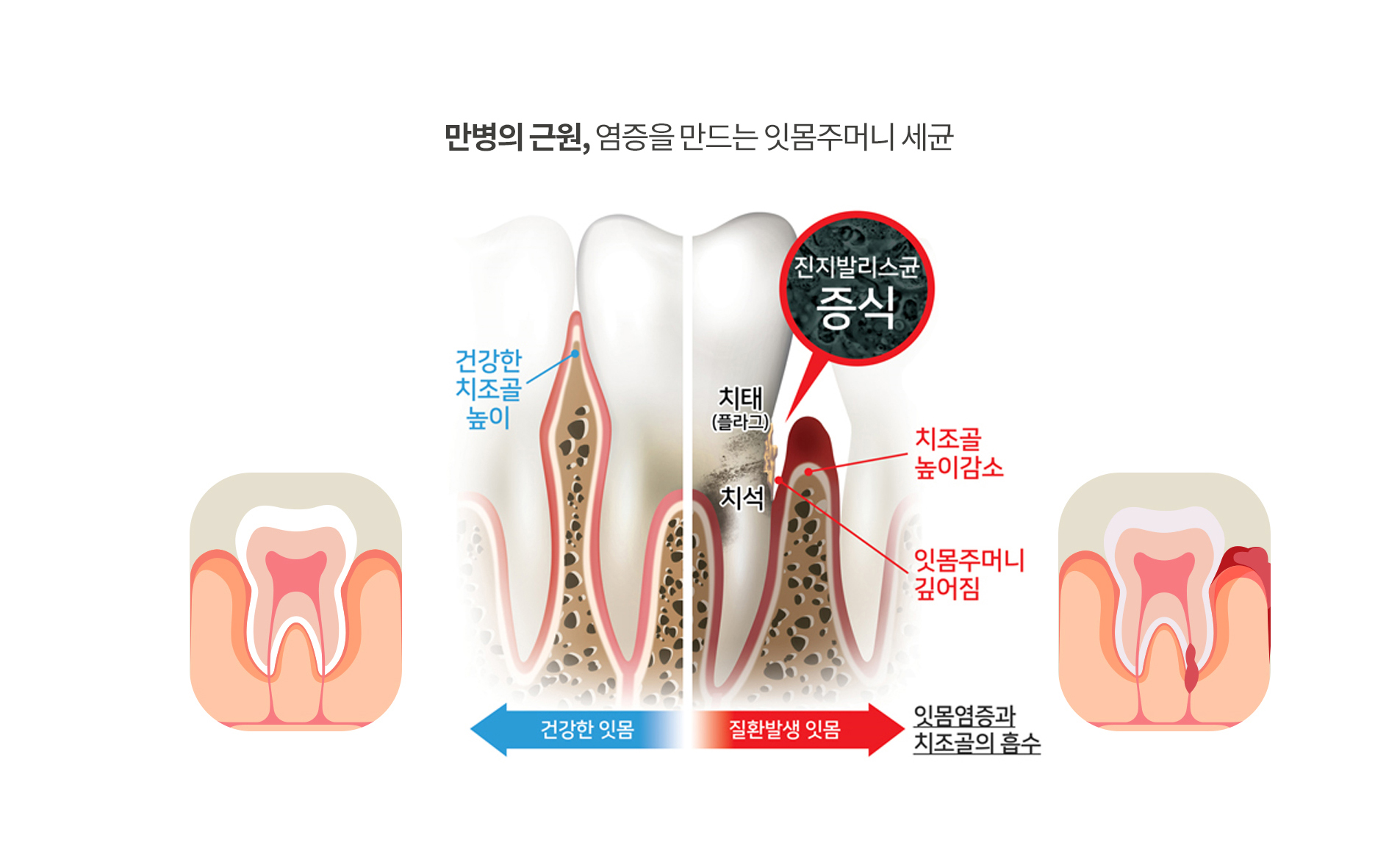 프리미엄 잇몸치료 과정